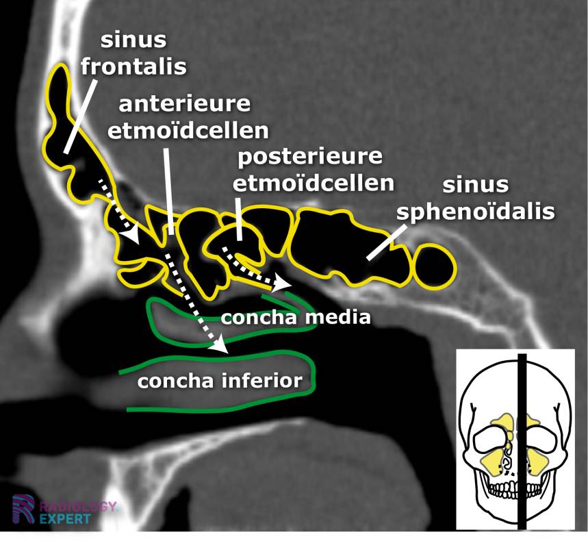 CT sinus